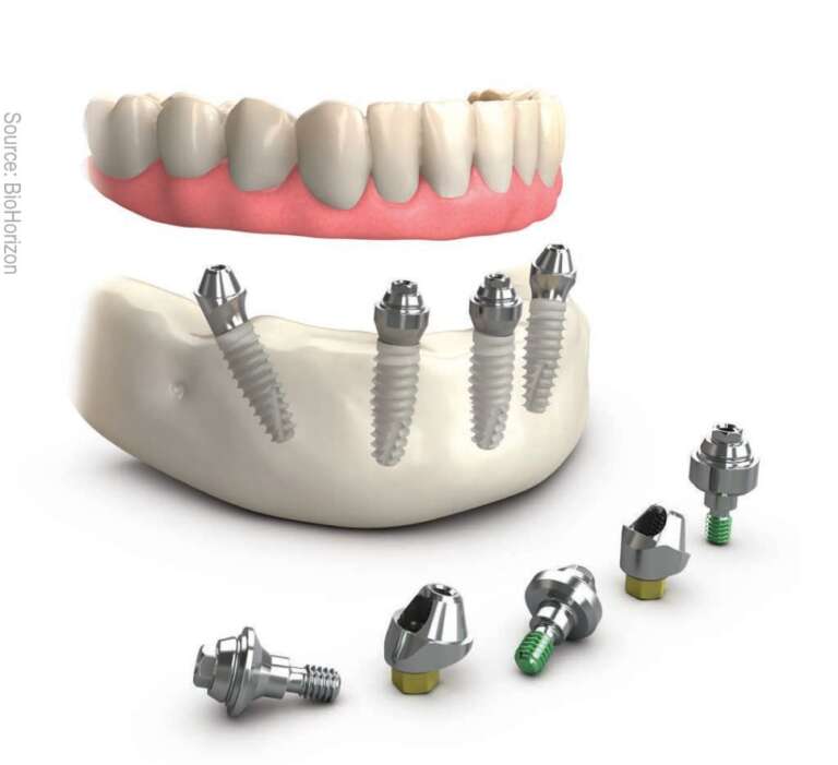 Full arch dental implants Dr Mathias